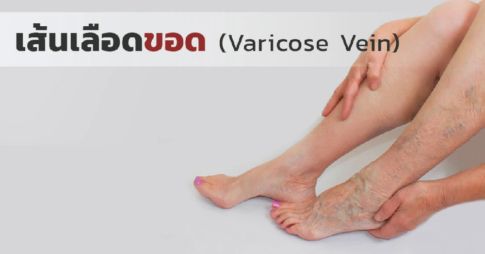 เส้นเลือดขอด (Varicose Vein) คืออะไร? สาเหตุ อาการ และปัจจัยเสี่ยง 