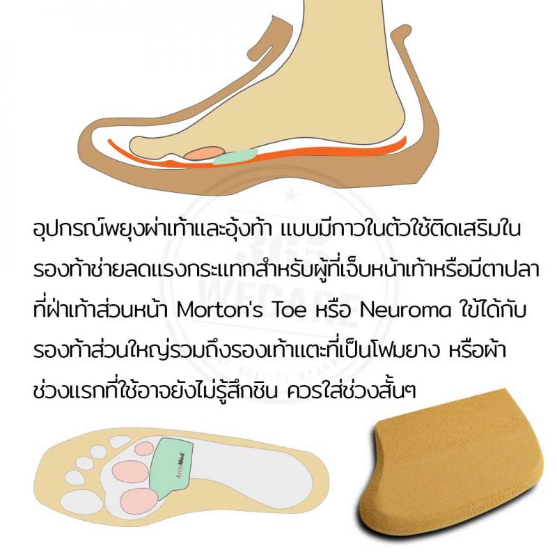 Archimed Metatarsal Bar Size L อาร์คิเมด