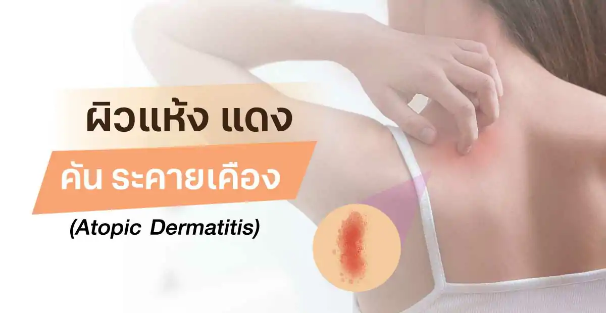 ผิวแห้ง แดง คัน ระคายเคือง