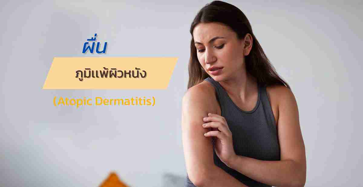 ผื่นภูมิแพ้ผิวหนัง (Atopic Dermatitis) สาเหตุ อาการ และแนวทางดูแล 